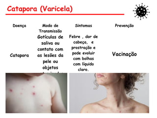Catapora (Varicela)
Doença Modo de
Transmissão
Sintomas Prevenção
Catapora
Gotículas de
saliva ou
contato com
as lesões da
pele ou
objetos
contaminados.
Febre , dor de
cabeça, e
prostração e
pode evoluir
com bolhas
com líquido
claro.
Vacinação
 