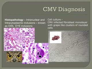 Cell culture -
CMV infected fibroblast monolayer
with grape like clusters of rounded
cells
Histopathology – Intranuclear and
Intracytoplasmic inclusions – known
as OWL EYE inclusions
 