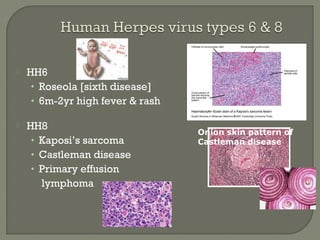  HH6
• Roseola [sixth disease]
• 6m-2yr high fever & rash
 HH8
• Kaposi’s sarcoma
• Castleman disease
• Primary effusion
lymphoma
Onion skin pattern of
Castleman disease
 