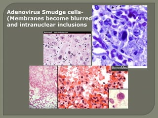 Adenovirus Smudge cells-
(Membranes become blurred)
and intranuclear inclusions
 