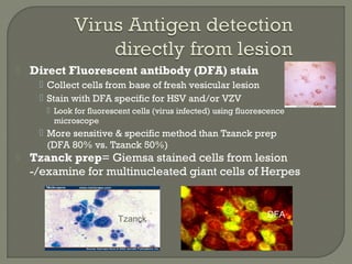  Direct Fluorescent antibody (DFA) stain
 Collect cells from base of fresh vesicular lesion
 Stain with DFA specific for HSV and/or VZV
 Look for fluorescent cells (virus infected) using fluorescence
microscope
 More sensitive & specific method than Tzanck prep
(DFA 80% vs. Tzanck 50%)
 Tzanck prep= Giemsa stained cells from lesion
-/examine for multinucleated giant cells of Herpes
Tzanck
Tzanck
DFA
 