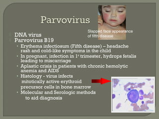  DNA virus
 Parvovirus B19
• Erythema infectiosum (Fifth disease) – headache
rash and cold-like symptoms in the child
• In pregnant, infection in 1st
trimester, hydrops fetalis
leading to miscarriage
• Aplastic crisis in patients with chronic hemolytic
anemia and AIDS
• Histology - virus infects
mitotically active erythroid
precursor cells in bone marrow
• Molecular and Serologic methods
to aid diagnosis
Slapped face appearance
of fifth disease
 