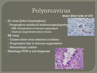 • JC virus [John Cunningham]
 Progressive multifocal leukoencephalopathy -
 PML -Encephalitis of immune suppressed
 Destroys oligodendrocytes in brain
• BK virus
 Causes latent virus infection in kidney
 Progression due to immune suppression
 Hemorrhagic cystitis
• Histology/PCR to aid diagnosis
Giant Glial Cells of JCV
 