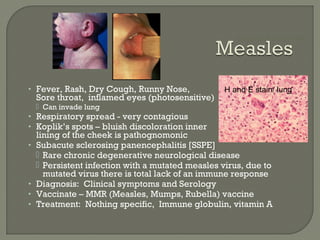 • Fever, Rash, Dry Cough, Runny Nose,
Sore throat, inflamed eyes (photosensitive)
 Can invade lung
• Respiratory spread - very contagious
• Koplik’s spots – bluish discoloration inner
lining of the cheek is pathognomonic
• Subacute sclerosing panencephalitis [SSPE]
 Rare chronic degenerative neurological disease
 Persistent infection with a mutated measles virus, due to
mutated virus there is total lack of an immune response
• Diagnosis: Clinical symptoms and Serology
• Vaccinate – MMR (Measles, Mumps, Rubella) vaccine
• Treatment: Nothing specific, Immune globulin, vitamin A
Measlessyncytium
H and E stain/ lung
 