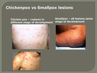 Chicken pox – Lesions in
different stage of development
Smallpox – all lesions same
stage of development
Chickenpox vs Smallpox lesions
 