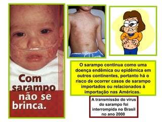 A transmissão do vírus
do sarampo foi
interrompida no Brasil
no ano 2000
O sarampo continua como uma
doença endêmica ou epidêmica em
outros continentes, portanto há o
risco de ocorrer casos de sarampo
importados ou relacionados à
importação nas Américas.
 