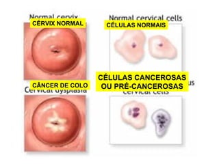 CÉRVIX NORMAL
CÂNCER DE COLO
CÉLULAS NORMAIS
CÉLULAS CANCEROSAS
OU PRÉ-CANCEROSAS
 