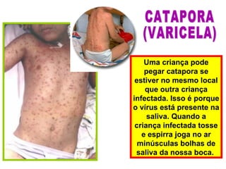 Uma criança pode
pegar catapora se
estiver no mesmo local
que outra criança
infectada. Isso é porque
o vírus está presente na
saliva. Quando a
criança infectada tosse
e espirra joga no ar
minúsculas bolhas de
saliva da nossa boca.
 
