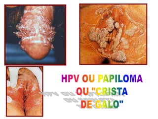 HPV OU PAPILOMAOU "CRISTADE GALO"