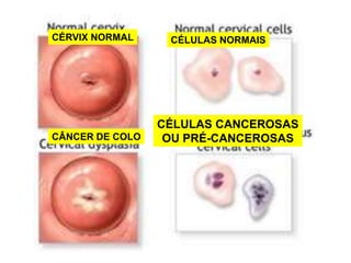 CÉRVIX NORMALCÉLULAS NORMAISCÉLULAS CANCEROSASOU PRÉ-CANCEROSASCÂNCER DE COLO
