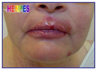 HERPES