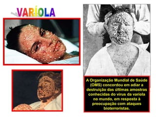 VARÍOLAA Organização Mundial de Saúde (OMS) concordou em adiar a destruição das últimas amostras conhecidas do vírus da varíola no mundo, em resposta à preocupação com ataques bioterroristas. 