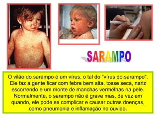 SARAMPOO vilão do sarampo é um vírus, o tal do "vírus do sarampo". Ele faz a gente ficar com febre bem alta, tosse seca, nariz escorrendo e um monte de manchas vermelhas na pele. Normalmente, o sarampo não é grave mas, de vez em quando, ele pode se complicar e causar outras doenças, como pneumonia e inflamação no ouvido.