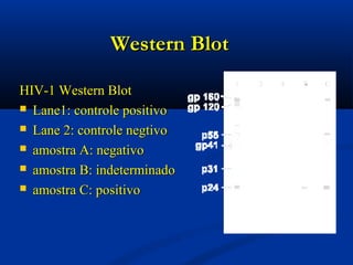 Western BlotWestern Blot
HIV-1 Western BlotHIV-1 Western Blot
 Lane1: controle positivoLane1: controle positivo
 Lane 2: controle negtivoLane 2: controle negtivo
 amostra A: negativoamostra A: negativo
 amostra B: indeterminadoamostra B: indeterminado
 amostra C: positivoamostra C: positivo
 