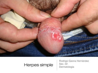 Herpes simple
Rodrigo Gaona Hernández
Sec. 02
Dermatología
 
