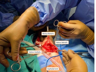 Rectus femoris
Vastus lateralis
Vastus medialis
Cephalad end
 
