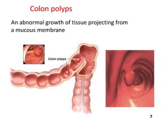 Colon polyps
An abnormal growth of tissue projecting from
a mucous membrane

7

 