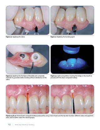 112 Winter 2014 • Volume 29 • Number 4
Figures 24 & 25: Intraoral pink composite buildup produced by using a micro brush and thin-tip stain brushes. Different colors and pigments
were used to better match the natural gingiva.
Figure 22: Applying the first layer of flowable pink composite
chairside to guarantee better bonding without interference of the
saliva.
Figure 23: Light-curing before inserting the bridge in the mouth to
proceed with the direct composite buildup.
Figure 20: Applying the silane. Figure 21: Applying the bonding agent.
 