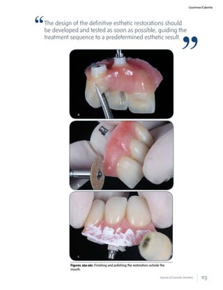 113Journal of Cosmetic Dentistry
Coachman/Calamita
Figures 26a-26c: Finishing and polishing the restoration outside the
mouth.
The design of the definitive esthetic restorations should
be developed and tested as soon as possible, guiding the
treatment sequence to a predetermined esthetic result.
a
b
c
 