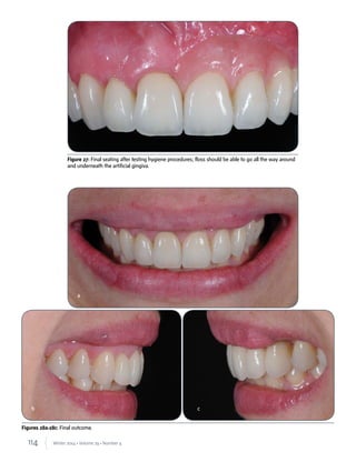 114 Winter 2014 • Volume 29 • Number 4
Figures 28a-28c: Final outcome.
Figure 27: Final seating after testing hygiene procedures; floss should be able to go all the way around
and underneath the artificial gingiva.
a
b c
 