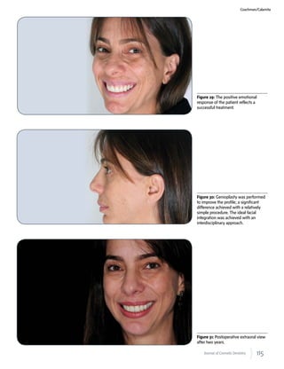115Journal of Cosmetic Dentistry
Coachman/Calamita
Figure 30: Genioplasty was performed
to improve the profile; a significant
difference achieved with a relatively
simple procedure. The ideal facial
integration was achieved with an
interdisciplinary approach.
Figure 31: Postoperative extraoral view
after two years.
Figure 29: The positive emotional
response of the patient reflects a
successful treatment.
 