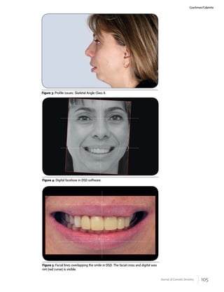 105Journal of Cosmetic Dentistry
Figure 3: Profile issues: Skeletal Angle Class II.
Figure 4: Digital facebow in DSD software.
Figure 5: Facial lines overlapping the smile in DSD. The facial cross and digital wax
rim (red curve) is visible.
Coachman/Calamita
 