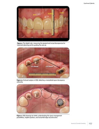 107Journal of Cosmetic Dentistry
Figure 9: The digital ruler, measuring the gingival and incisal discrepancies for
treatment planning and for guiding the wax-up.
Figure 10: Occlusal analysis in DSD, detecting a mesiodistal space discrepancy
anteriorly.
Figure 11: DSD drawings for better understanding the space management
possibilities, implant position, and horizontal ridge reconstruction.
Coachman/Calamita
 