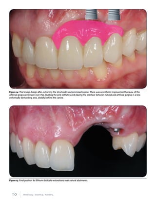 110 Winter 2014 • Volume 29 • Number 4
Figure 14: The bridge design after extracting the structurally compromised canine. There was an esthetic improvement because of the
artificial gingiva extension over #23, leveling the pink esthetics and placing the interface between natural and artificial gingiva in a less
esthetically demanding area, distally behind the canine.
Figure 15: Final position for lithium disilicate restorations over natural abutments.
 