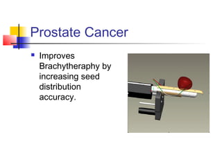 Prostate Cancer
 Improves
Brachytheraphy by
increasing seed
distribution
accuracy.
 