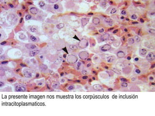 LESIONESLESIONES MACROSCOPICAS: Al inicio de la enfermedad se muestran pequeñas vesículas ,en zonas desprovista de plumas, posteriormente se convierten en pústulas, mas adelante en costras particularmente en cresta, barbillas, comisura del pico, tarsos estas lesiones se presentan en la forma seca; en la forma húmeda hay la presencia de membranas diftéricas blanco-amarillentas en cavidad bocal ,faringe y esófago. 