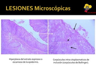 ECUADOR

Hiperplasia del estrato espinoso o
escamoso de la epidermis.

Corpúsculos intra citoplasmaticos de
inclusión (corpúsculos de Bollinger).

 