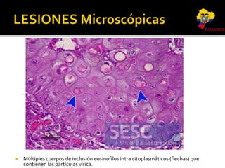 ECUADOR



Múltiples cuerpos de inclusión eosinófilos intra citoplasmáticos (flechas) que
contienen las partículas vírica.

 