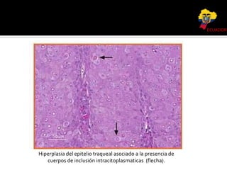ECUADOR

Hiperplasia del epitelio traqueal asociado a la presencia de
cuerpos de inclusión intracitoplasmaticas (flecha).

 