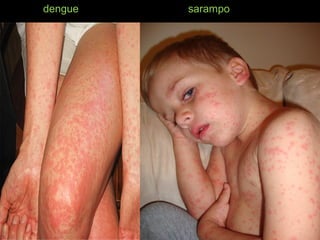 dengue sarampo
 
