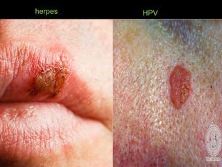 herpes HPV
 