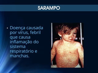 SARAMPO

•

Doença causada
por vírus, febril
que causa
inflamação do
sistema
respiratório e
manchas.

 