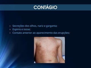 CONTÁGIO

•
•
•

Secreções dos olhos, nariz e garganta;
Espirro e tosse;
Contato anterior ao aparecimento das erupções;

 