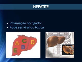 HEPATITE

Inflamação no fígado;
• Pode ser viral ou tóxica;
•

 