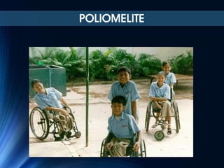 POLIOMELITE

 