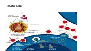 Influenza (Gripe)
 
