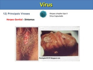 12) Principais Viroses
Herpes Genital - Sintomas
Herpes simplex tipo II
Vírus Capsulado
VírusVírus
 