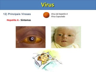 12) Principais Viroses
Hepatite A - Sintomas
Vírus da hepatite A
Vírus Capsulado
VírusVírus
 