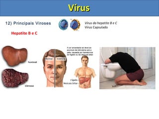 12) Principais Viroses
Hepatite B e C
Vírus da hepatite B e C
Vírus Capsulado
VírusVírus
 