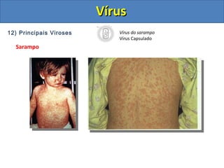 12) Principais Viroses
Sarampo
Vírus do sarampo
Vírus Capsulado
VírusVírus
 
