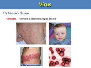 12) Principais Viroses
Catapora – (Varicela, Cobreiro ou Hepes-Zóster)
VírusVírus
 