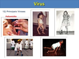 12) Principais Viroses
Poliomielite
VírusVírus
 