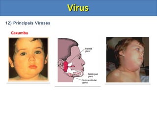 12) Principais Viroses
Caxumba
VírusVírus
 