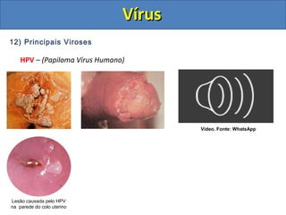 12) Principais Viroses
HPV – (Papiloma Vírus Humano)
Lesão causada pelo HPV
na parede do colo uterino
Vídeo. Fonte: WhatsApp
VírusVírus
 
