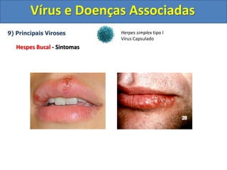 Vírus e Doenças Associadas
9) Principais Viroses
Hespes Bucal - Sintomas
Herpes simplex tipo I
Vírus Capsulado
 