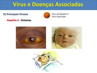 Vírus e Doenças Associadas
9) Principais Viroses
Hepatite A - Sintomas
Vírus da hepatite A
Vírus Capsulado
 